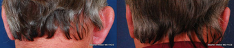 Ear Surgery before 1445737