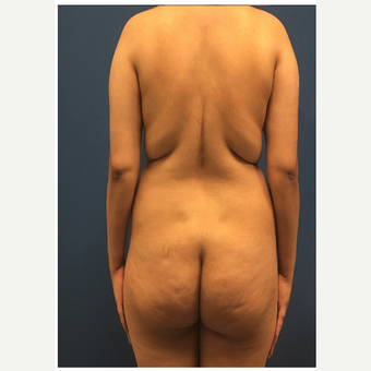 35-44 year old woman treated with Brazilian Butt Lift before 3749250