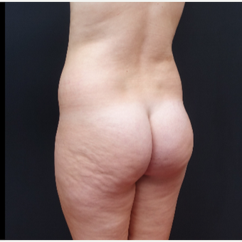 18-24 year old woman treated with Fat Transfer before 3315540
