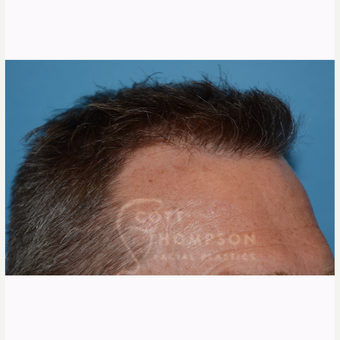 45-54 year old man treated with NeoGraft after 3366609