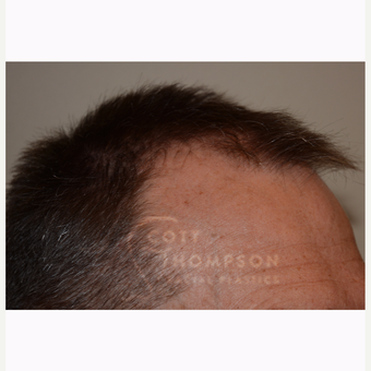 45-54 year old man treated with NeoGraft before 3366609