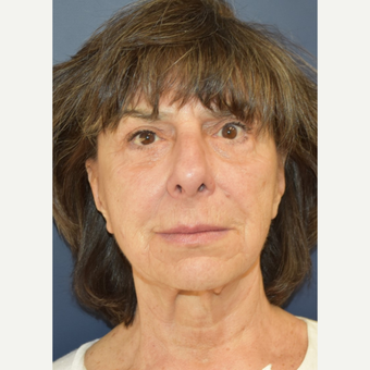 65-74 year old woman treated with Neck Lift before 3214022
