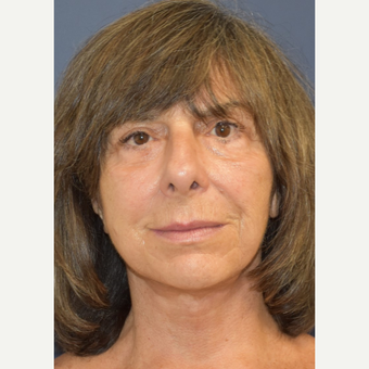 65-74 year old woman treated with Neck Lift after 3214022