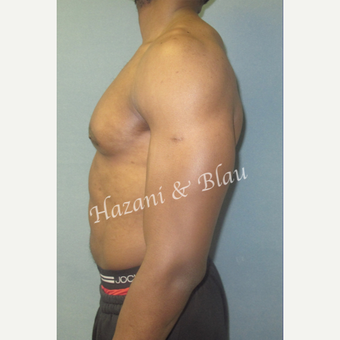 35-44 year old man treated with Male Breast Reduction after 3333021