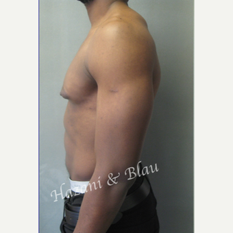 35-44 year old man treated with Male Breast Reduction before 3333021