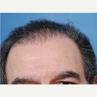 65-74 year old man treated with 2 sessions of Hair Transplantation before 3577751