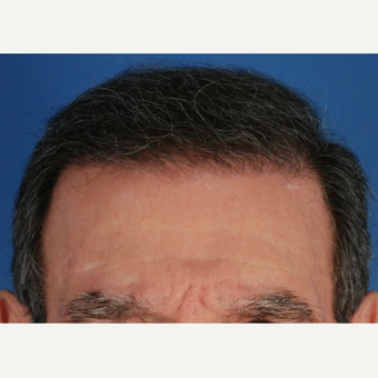 65-74 year old man treated with 2 sessions of Hair Transplantation after 3577751