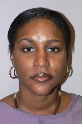 37 year old woman has Rhinoplasty after 984292