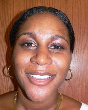 37 year old woman has Rhinoplasty before 984292