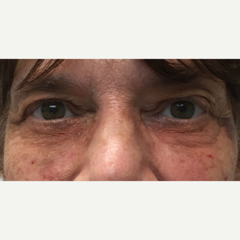 65-74 year old woman treated with Restylane after 3255733