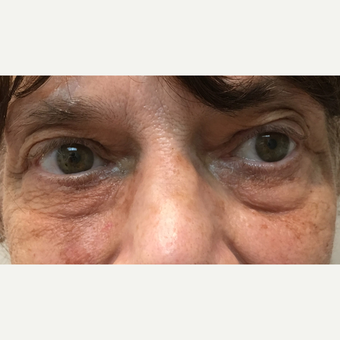 65-74 year old woman treated with Restylane before 3255733