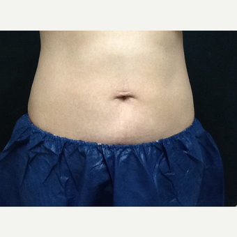 25-34 year old woman treated with CoolSculpting after 3382765