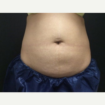 25-34 year old woman treated with CoolSculpting before 3382765