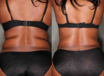 39 Year Old Female Treated with Liposuction for unwanted Fat before 1046511