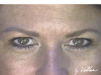 Transconjunctival Blepharoplasty after 983156