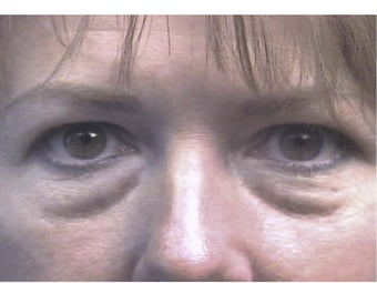 Transconjunctival Blepharoplasty before 983156