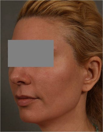 43 Year Old Female with early volume changes to cheeks requesting Juvederm Voluma after 1361090