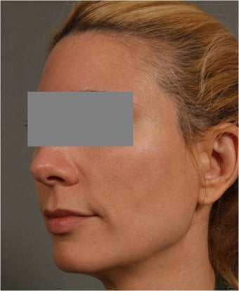 43 Year Old Female with early volume changes to cheeks requesting Juvederm Voluma before 1361090