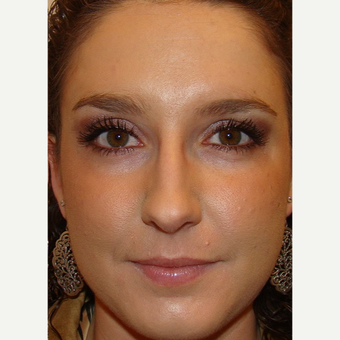 25-34 year old woman treated with Dysport after 3664848