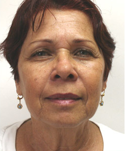 Mini Face Lift with Bilateral Brow Lift before 925641