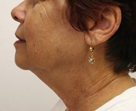 Mini Face Lift with Bilateral Brow Lift 925641