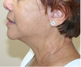 Mini Face Lift with Bilateral Brow Lift 925641