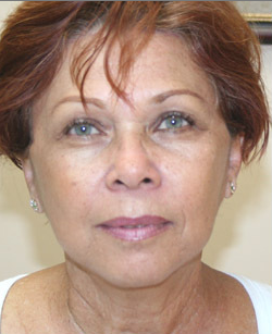 Mini Face Lift with Bilateral Brow Lift after 925641