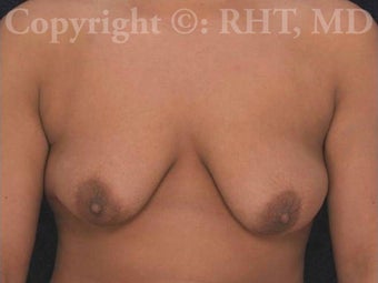 26 year-old F to M transgender patient underwent outpatient "top surgery" before 1304416