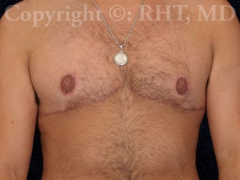 26 year-old F to M transgender patient underwent outpatient "top surgery" after 1304416