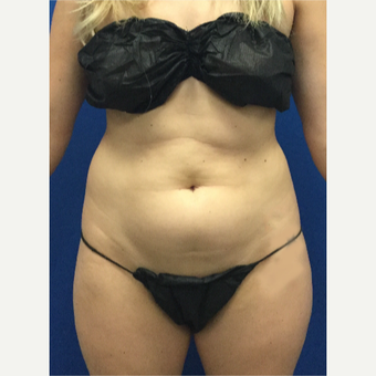 25-34 year old woman treated with Laser Liposuction before 3696995