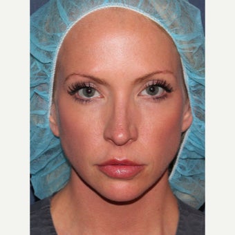 31 year old woman treated with Voluma in temples after 1783242