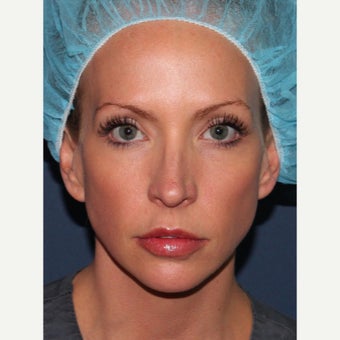 31 year old woman treated with Voluma in temples before 1783242