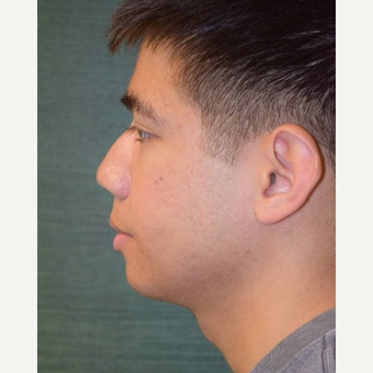 18-24 year old man treated with Rhinoplasty before 3287288