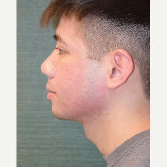 18-24 year old man treated with Rhinoplasty after 3287288