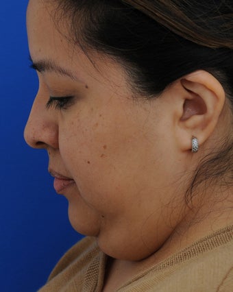 45-54 year old woman treated with Lower Face Lift 2897993