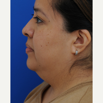 45-54 year old woman treated with Lower Face Lift before 2897993