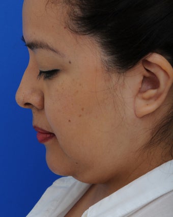 45-54 year old woman treated with Lower Face Lift 2897993