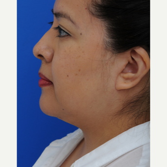 45-54 year old woman treated with Lower Face Lift after 2897993