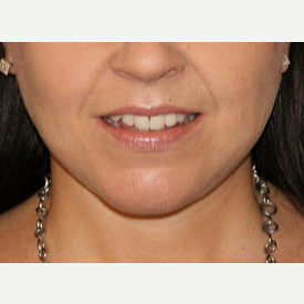 45-54 year old woman treated with Facelift, Necklift after 3065361
