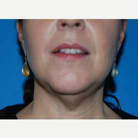 45-54 year old woman treated with Facelift, Necklift before 3065361