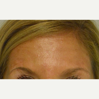 45-54 year old woman treated with Botox who does not like her forehead lines above the brows at rest after 2975686