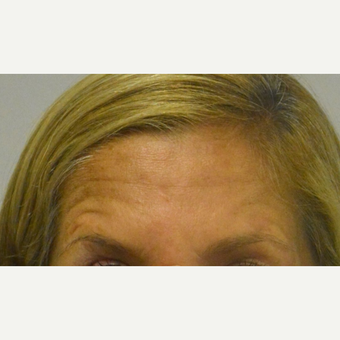 45-54 year old woman treated with Botox who does not like her forehead lines above the brows at rest before 2975686