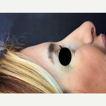 25-34 year old woman treated with Rhinoplasty before 3211776