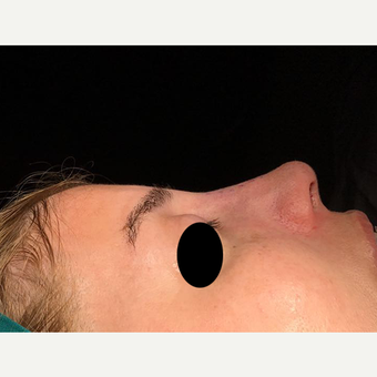 25-34 year old woman treated with Rhinoplasty after 3211776