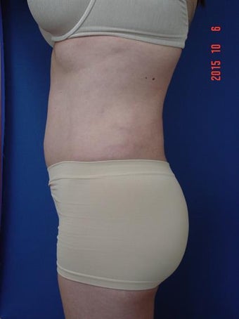 Brazilian Butt Lift 2319040