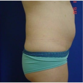 Brazilian Butt Lift before 2319040