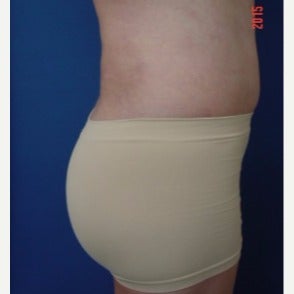 Brazilian Butt Lift after 2319040