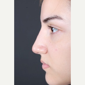 18-24 year old woman treated with Non Surgical Nose Job after 3011300