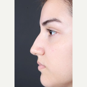18-24 year old woman treated with Non Surgical Nose Job before 3011300