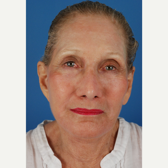 77 year old woman treated with facelift Revision and endoscopic brow lift after 3577879